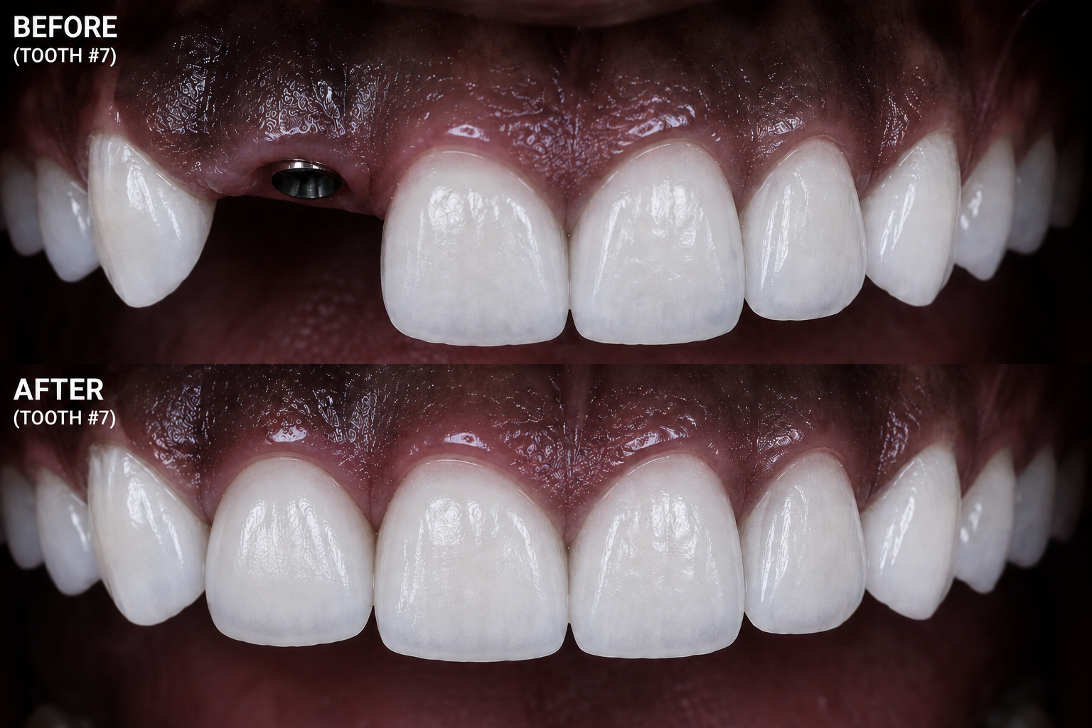 Before and after: tooth number 7 lateral incisor replaced with implant-supported crown