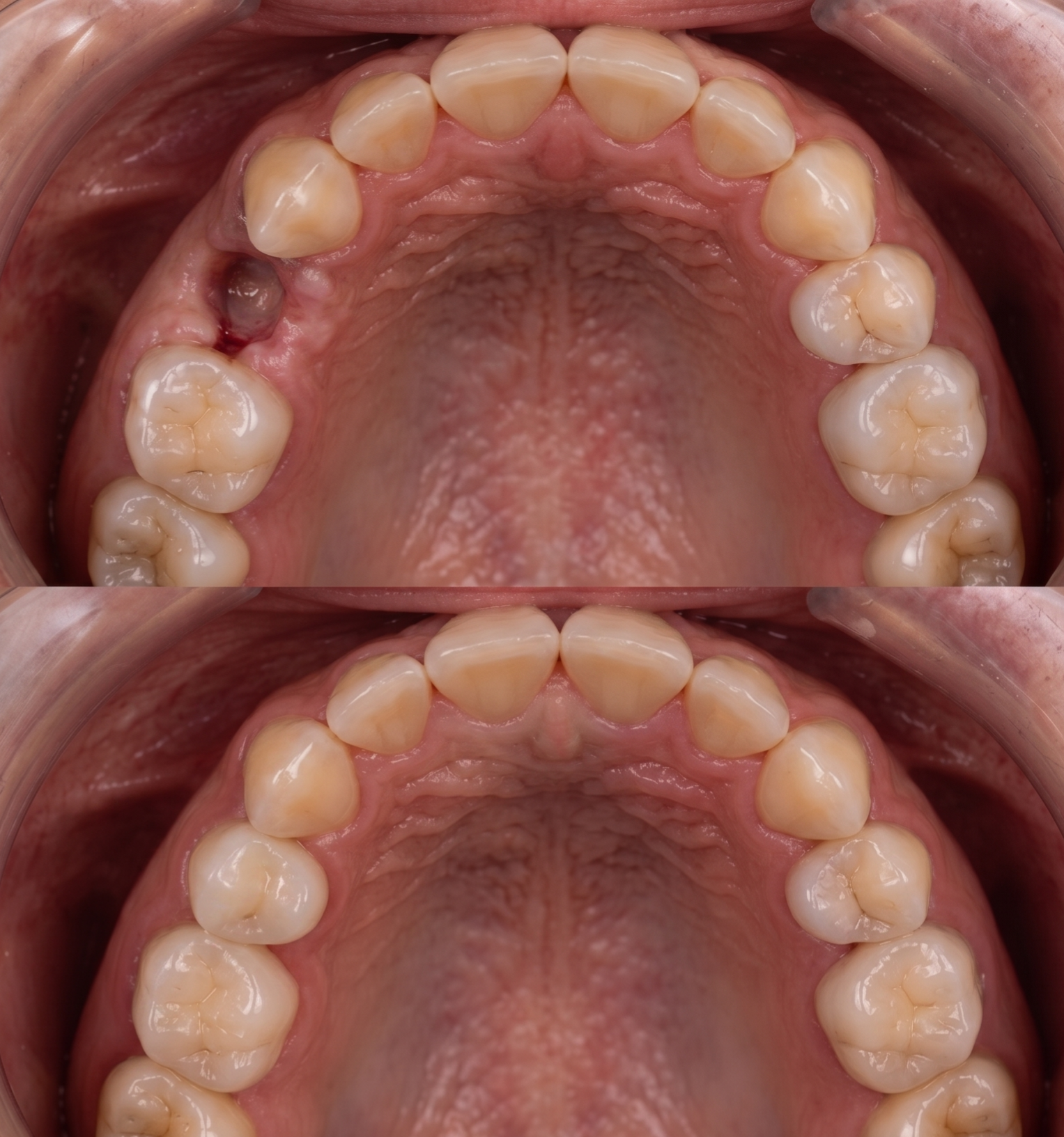Before and after: premolar tooth replaced with single dental implant
