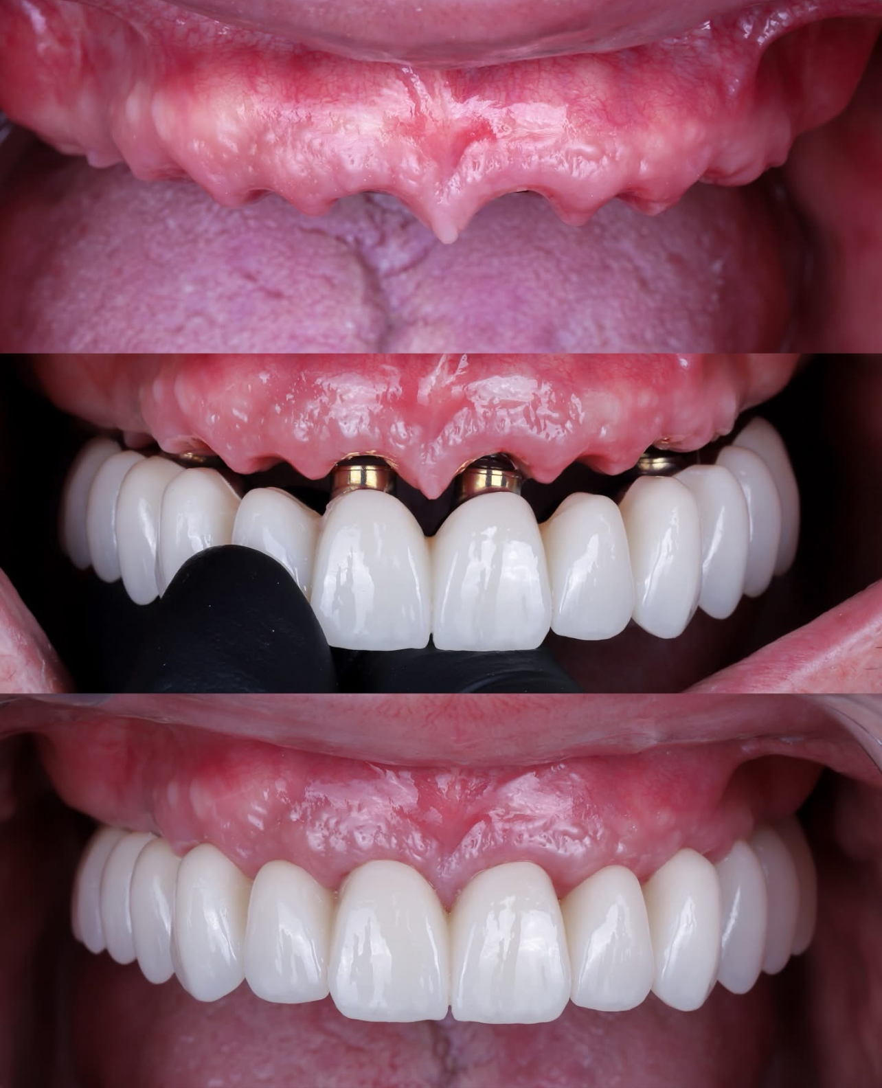 Before and after: full upper arch restored with All-on-4 fixed hybrid bridge
